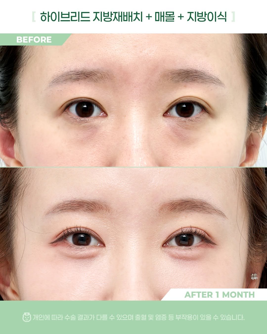 Photo by 비포애프 박재범 on January 06, 2026. May be an image of text that says '하이브리드 하이 브리드 지방재배치 + 매몰 + 지방이식 BEFORE AFTER AFTER1MONTH 1 MONTH 개인에 따라 수술 결과가 다를 수 있으며 출혈 및 염증 등 부작용이 있을 수 있습니다.'.