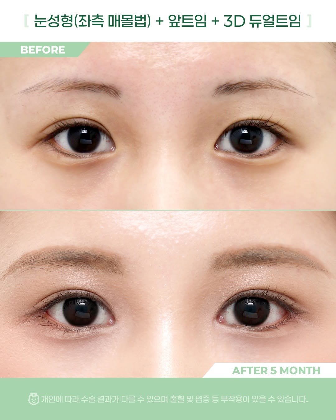Photo by 비포애프 박재범 on April 09, 2026. May be an image of text that says 'BEFORE 눈성형 (좌측 매몰법) + 앞트임 + 3D 듀얼트임 ាពនសរ AFTER AFTER5MONTH 5 MONTH 개인에 따라 수술 결과가 개인에따라수술결과가대 다를 수 있으며 출혈 및 염증 등 부작용이 있을 수 있습니다.'.