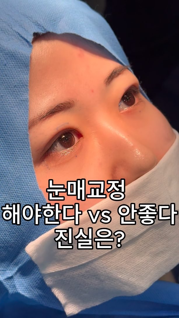 b4fps_official 게시물 이미지: 눈매교정 하라던데... 지방도 빼야하는건지..
안검하수도 진짜 안검하수와 가성...