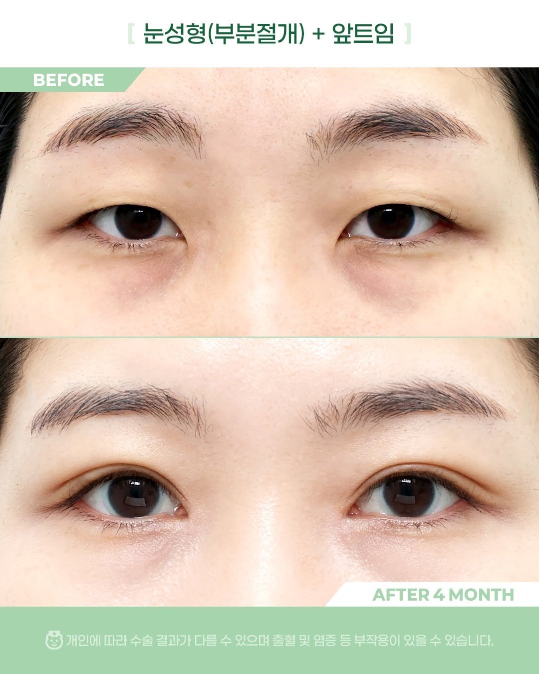 Photo by 비포애프 박재범 on April 09, 2026. May be an image of text that says 'BEFORE 눈성형 형(부분절개) + 앞트임 AFTER AFTER4MONTH 4 MONTH 개인에 따라 수술 결과가 다를 수 있으며 출혈 및 염증 등 부작용이 있을 수 있습니다.'.