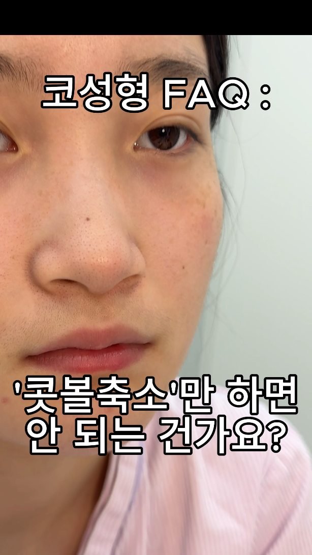 b4fps_official 게시물 이미지: "콧볼축소"만 하면 안될까요? 가장 많이 물어보는 질문입니다. 코성형이 걱정되고...