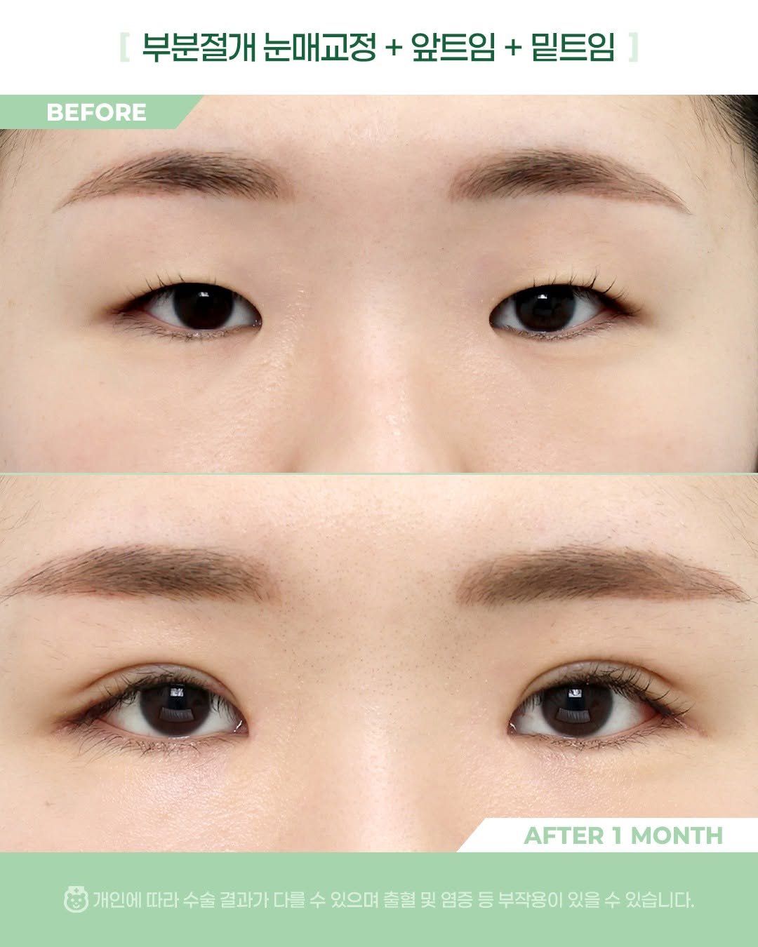 Photo by 비포애프 박재범 on December 28, 2025. May be an image of text that says 'BEFORE 부분절개 눈매교정 + 앞트임 + 밑트임 AFTER AFTER1MONTH 1 MONTH 개인에 따라 수술 결과가 다를 수 있으며 출혈 및 염증 등 부작용이 있을 수 있습니다.'.