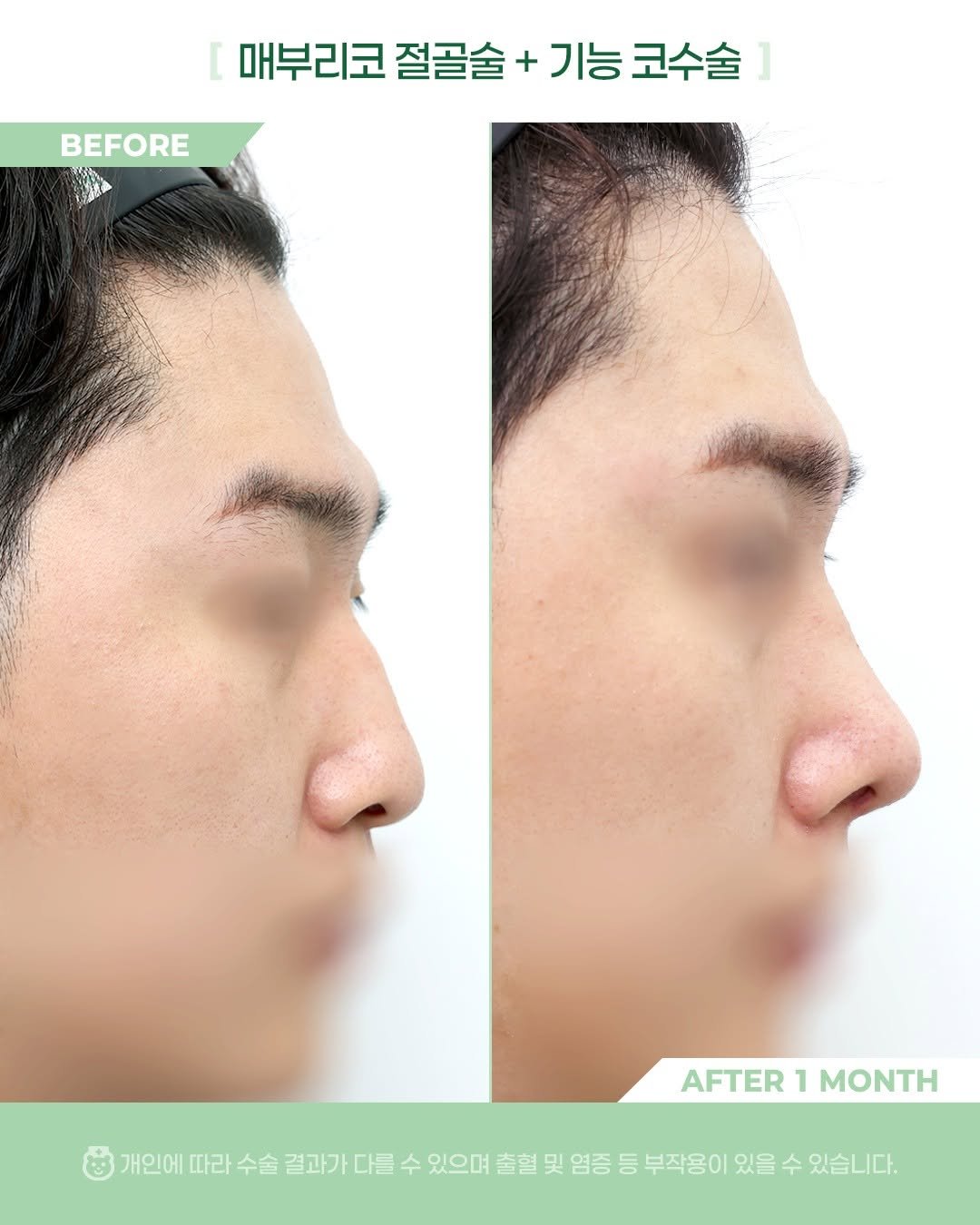 Photo by 비포애프 박재범 on April 02, 2026. May be an image of text that says 'BEFORE 매부리코 절골술 매부리코절골술+기능코수술 + 기능 코수술 AFTER AFTER1MONTH 1 MONTH 개인에 따라 수술 결과가 다를 수 있으며 출혈 및 염증 등 부작용이 있을 수 있습니다.'.