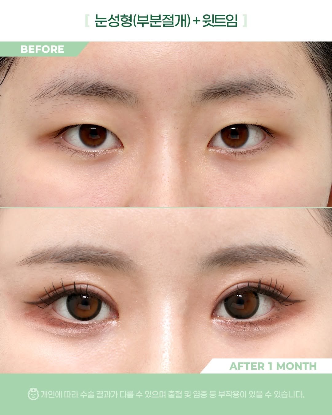 Photo by 비포애프 박재범 on December 28, 2025. May be an image of text that says 'BEFORE 눈성형 (부분절개) 눈성형(부분절개)+ + 윗트임 AFTER AFTER1MONTH 1 MONTH 개인에 따라 수술 결과가 결과가다를 다를 수 있으며 출혈 및 염증 등 부작용이 있을 수 있습니다.'.