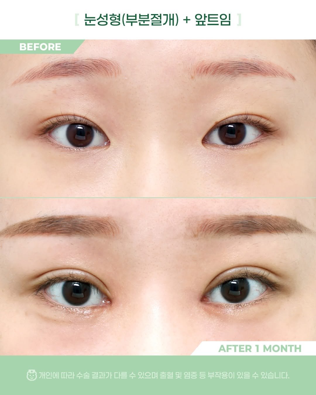 Photo by 비포애프 박재범 on February 10, 2026. May be an image of one or more people, eyeliner and text that says 'BEFORE 눈성형( (부분절개) 눈성형(부분절개) + 앞트임 AFTER AFTER1MONTH 1 MONTH 개인에 따라 수술 결과가 다를 수 있으며 출혈 및 염증 등 부작용이 있을 수 있습니다.'.
