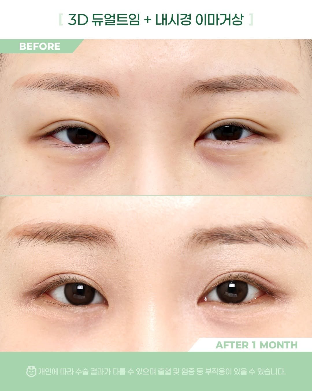 Photo by 비포애프 박재범 on April 13, 2026. May be an image of one or more people, eyeliner and text that says '3D 듀얼트임 + 내시경 이마거상 BEFORE AFTER AFTER1MONTH 1 MONTH 개인에 따라 수술 결과가 다를 수 있으며 출혈 및 염증 등 부작용이 있을 수 있습니다.'.