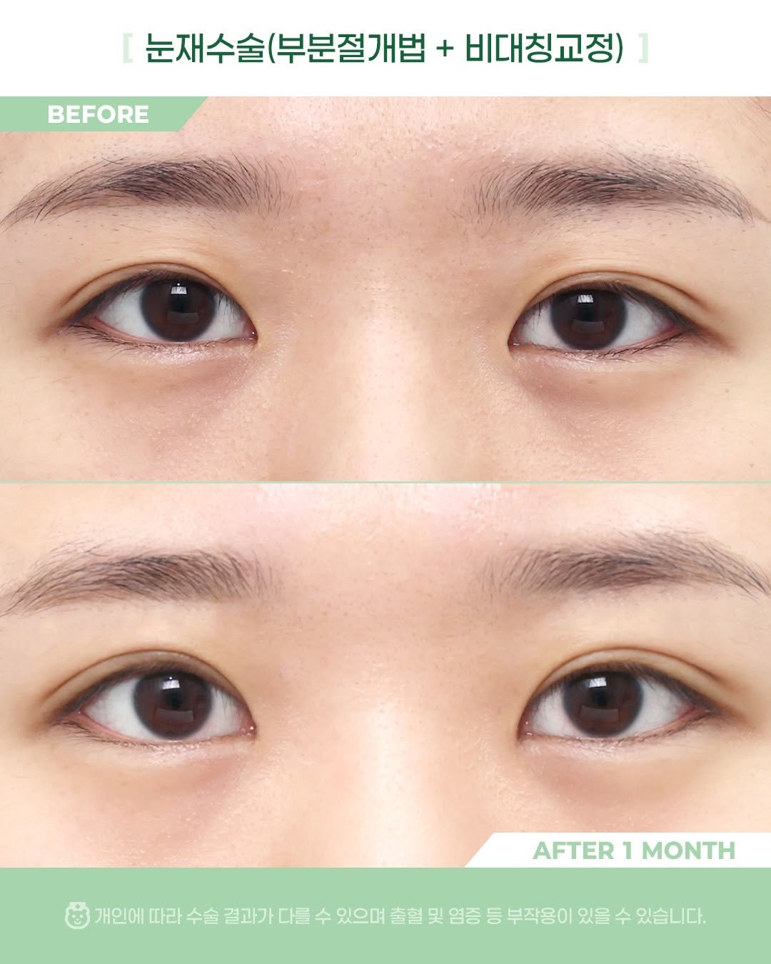 Photo by 비포애프 박재범 on October 21, 2025. May be an image of text that says 'BEFORE 눈재수술 (부분절개법 눈재수술(부분절개법 + 비대칭교정) AOAL AFTER AFTER1MONTH 1 MONTH 개인에 따라 수술 결과가 다를 수 있으며 출혈 및 염증 등 부작용이 있을 수 있습니다.'.