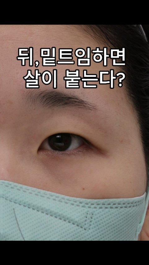 b4fps_official 게시물 이미지: 뒤밑트임하면 살끼리 붙는다.ㄷ자로 낫는다..
요즘은 아닙니다!
- 수술명 :...