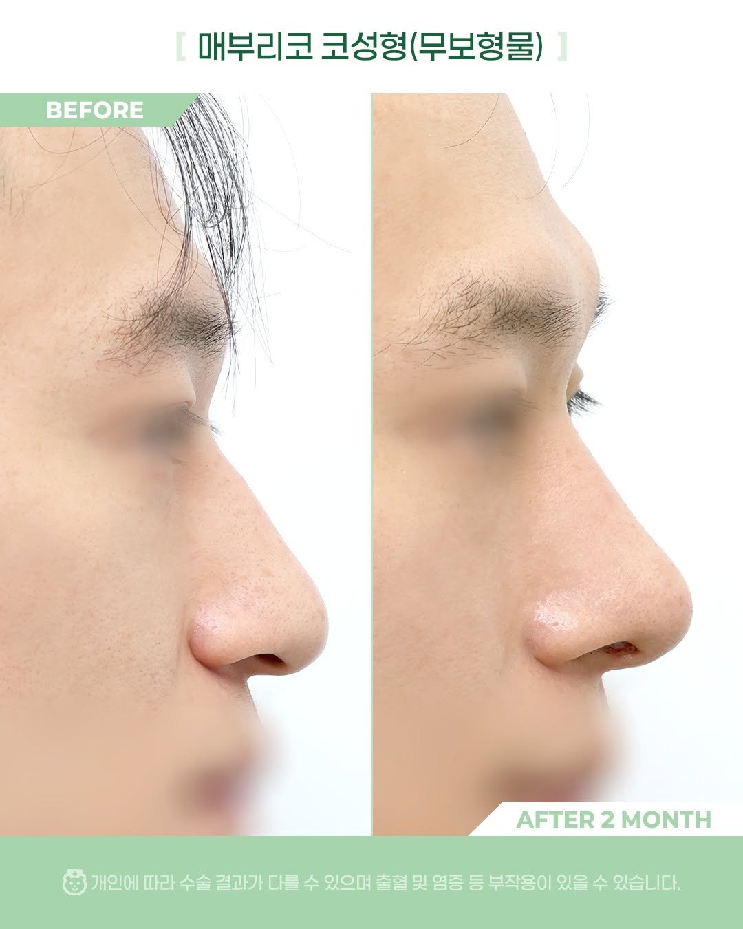 Photo by 비포애프 박재범 on April 02, 2026. May be an image of text that says 'BEFORE [매부리코코성형(무보형물) [ 매부리코 코성형 (무보형물) AFTER AFTER2MONTH 2 MONTH 개인에 따라 수술 결과가 다를 수 있으며 출혈 및 염증 등 부작용이 있을 수 있습니다.'.