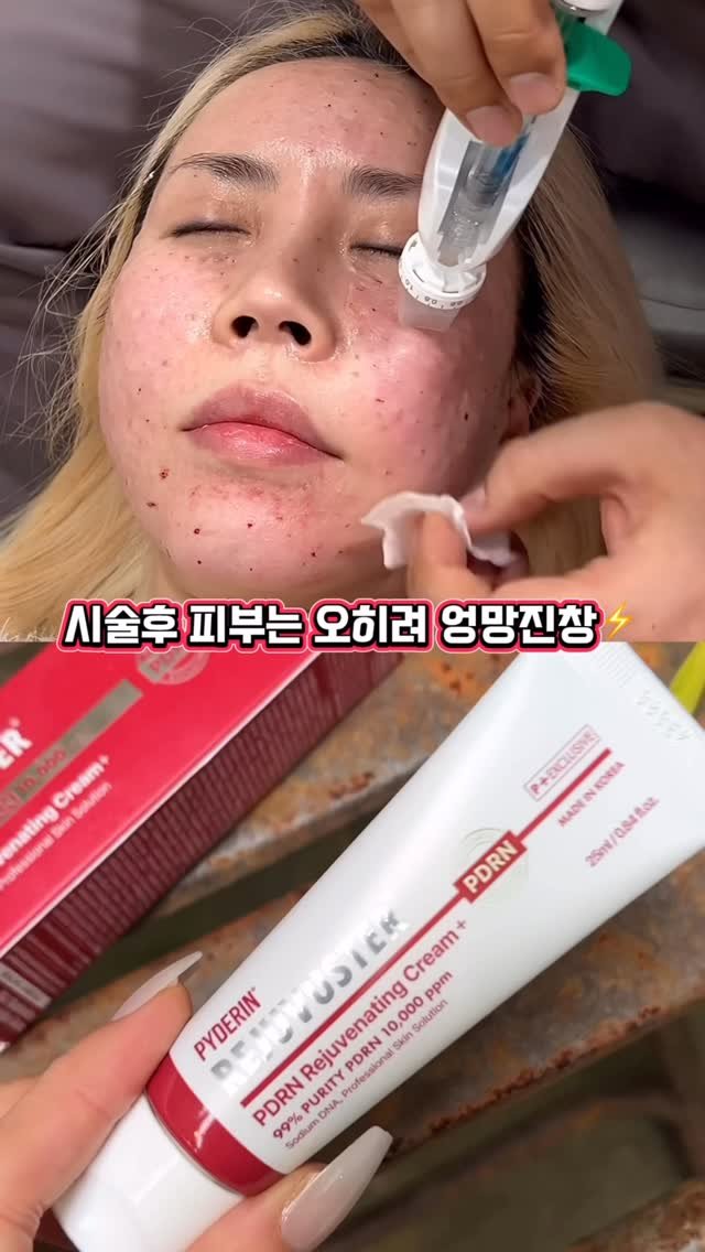 bada_pinky 게시물 이미지: #광고 
시술후 난리난 피부관리 어떻게 하고계신가요??
설마 평소랑 똑같이 하는건...