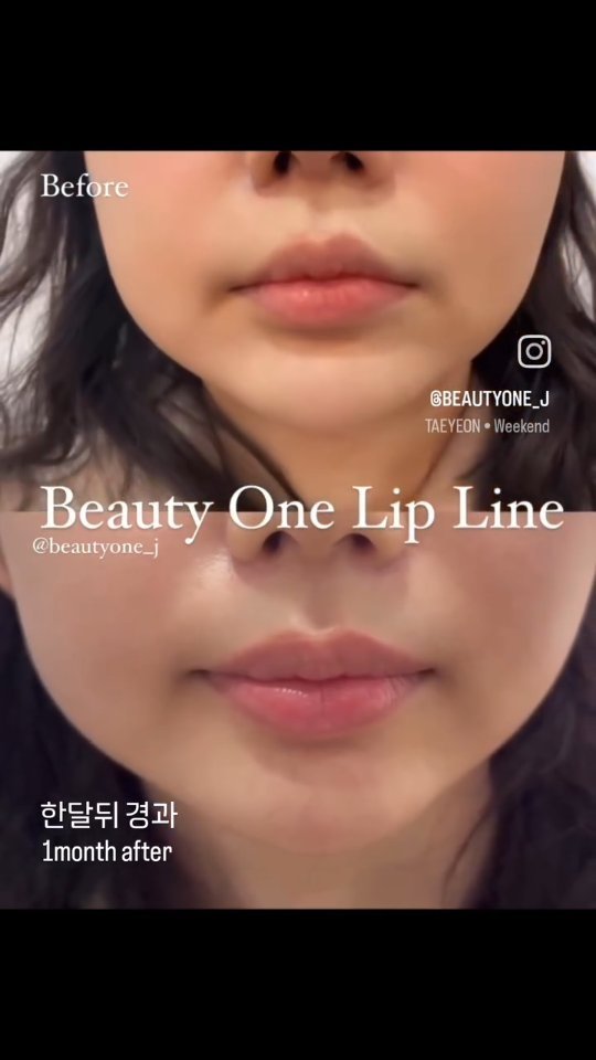 beautyone_j 게시물 이미지: (한달후 경과 영상이예요)필러로도 안되는 #입술복원 & 말린입술 확장 이건...