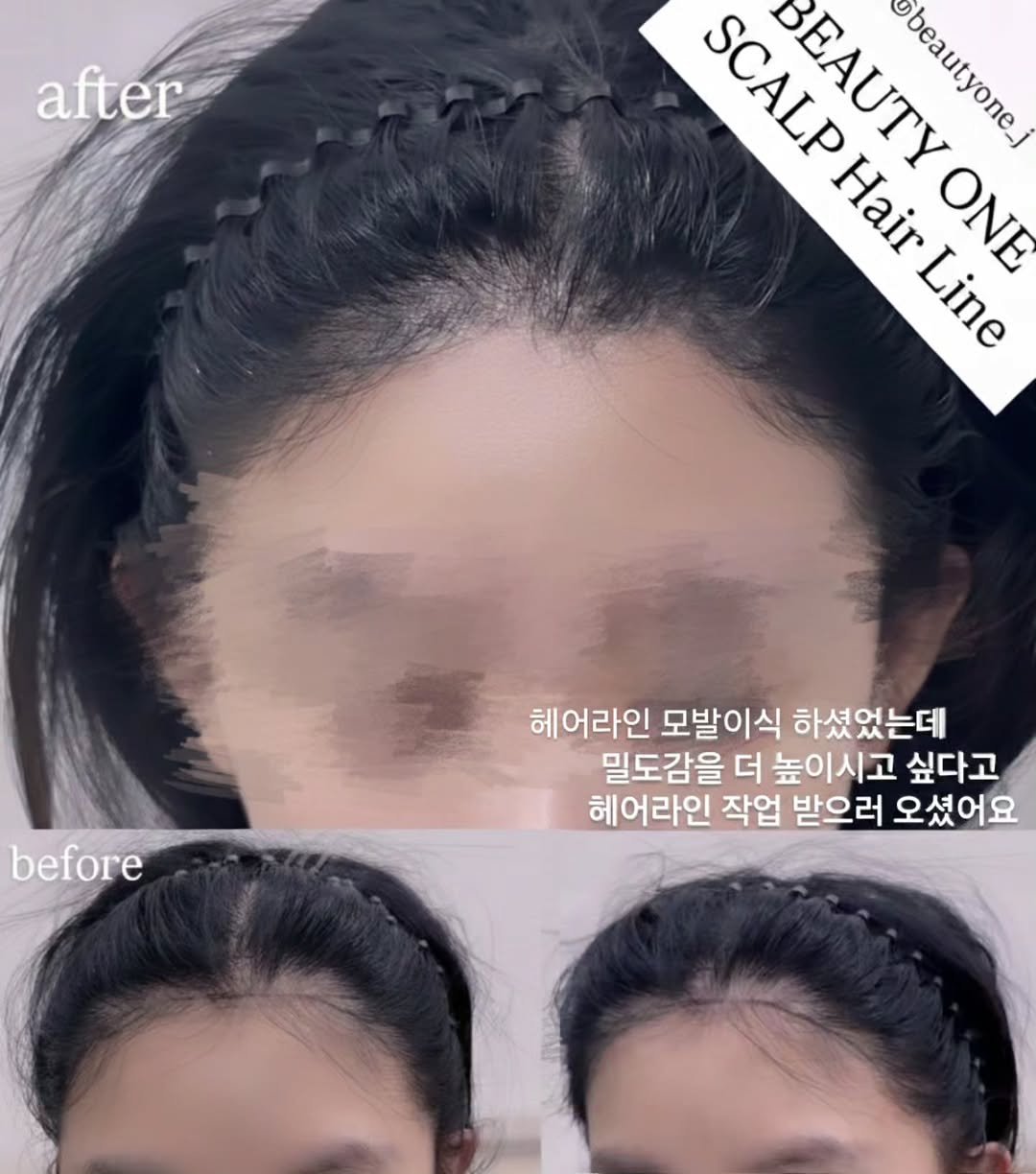 Photo by KoreaMicroblading 韓國 アートメイク 강남눈썹문신 남자눈썹문신 입술문신 남자입술문신 반영구수강 뷰티원 in 강남 (Gangnam) with @beautyone_scalp. May be an image of one or more people, hair, hair product and text that says 'after SCALE SCALP BEAUTY ΠΡΛυy ងលេរ្វ beautyone_ Hair ONE Line before 헤어라인 모발이식 하셨었는데 밀도감을 더 높이시고 싶다고 헤어라인 작업 받으러 오셨어요'.