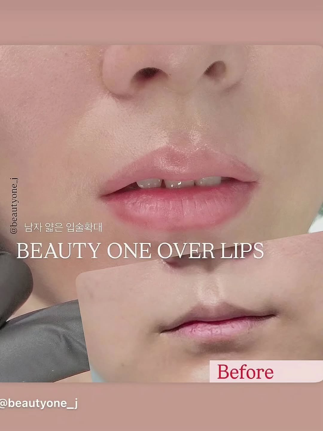 Photo by アートメイク 韓國 눈썹문신 강남 남자눈썹문신 입술문신 남자입술문신 반영구수강 반영구학원 뷰티원 in Seoul, Korea. May be an image of one or more people, lipstick and text that says 'ena 남자 앎은 입술확대 BEAUTY ΟΝΕ OVER LIPS @beautyone_j Before'.