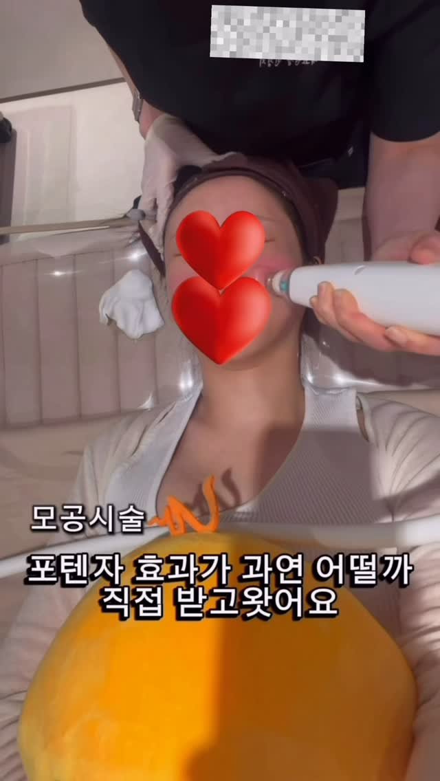 bellea___ 게시물 이미지: 이번달 관리는 모공시술로 선택햇어용
포텐자 받고 피부결 진짜 미쳤어요!

모공이랑...
