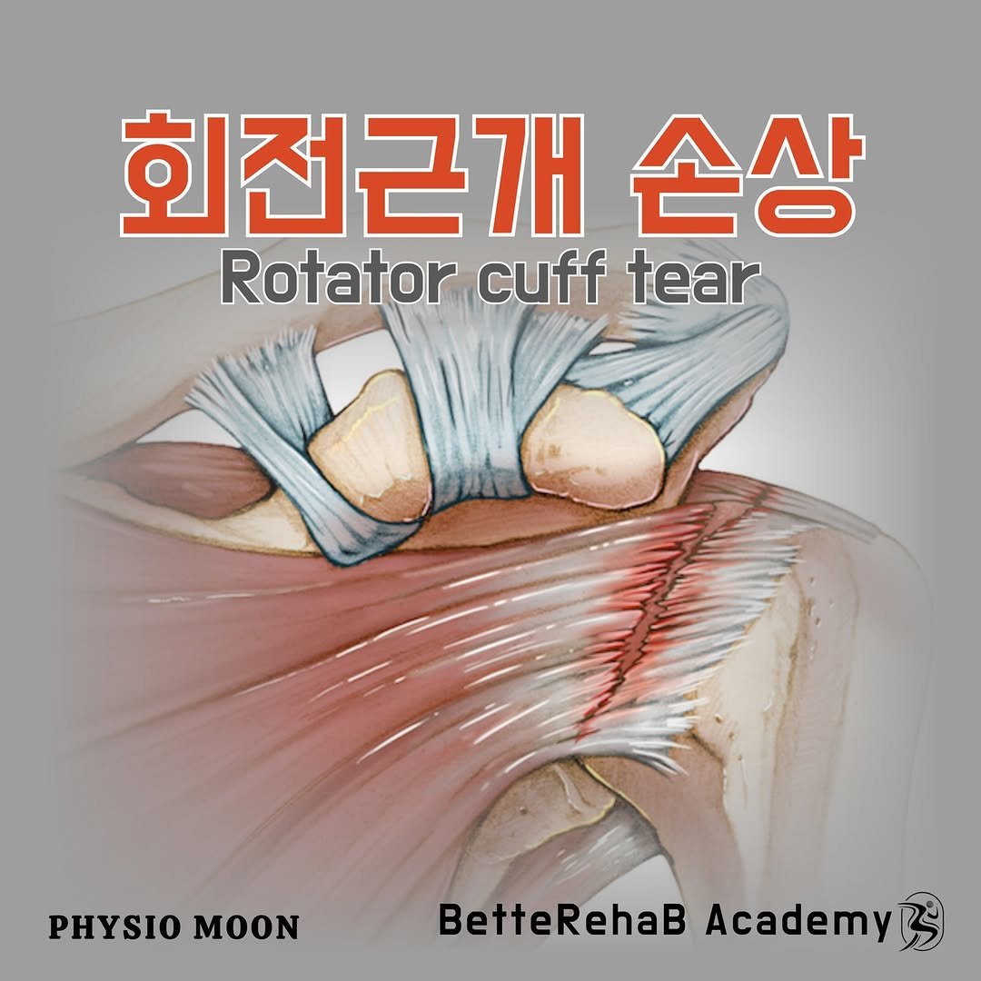 Photo by BetteRehab on February 10, 2025. May be an image of text that says '회전근개 손상 Rotator Rotatorcufftear cuff tear PHYSIO PHYSIOMOON MOON BetteRehaB BetteRehaBAcademy Academy! BS'.