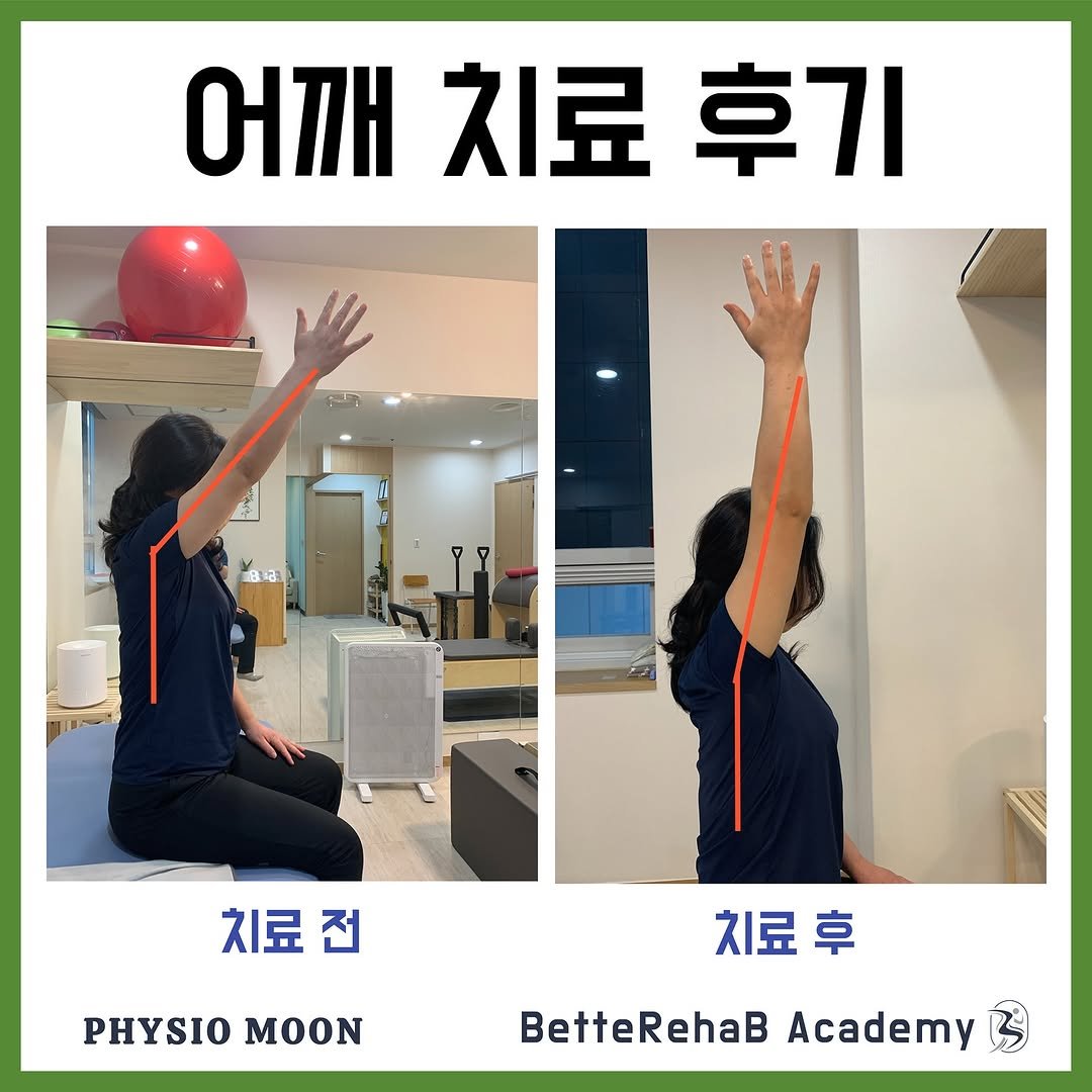 Photo by BetteRehab on February 05, 2025. May be an image of ‎2 people and ‎text that says '‎어깨 치료 후기 جم 8记 치료전 전 PHYSIO PHYSIOMOON ΜΟΟΝ 치료 지도후 BetteRehaB BetteRehaBAcademy Academy‎'‎‎.