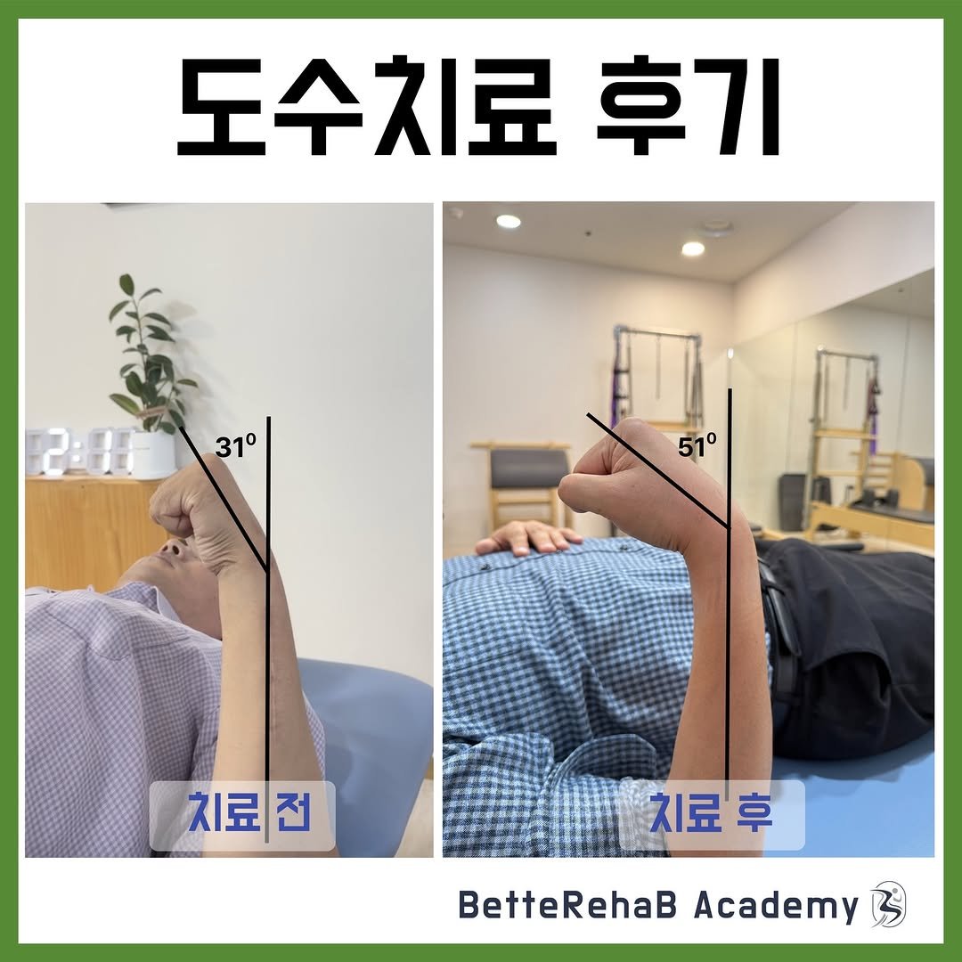 Photo by betterehab_academy on January 07, 2026. May be an image of acupuncture and text that says '도수치료 후기 310 31° 51° 치료전 SE 치료후 후 치료 BetteRehaBAcademy BetteRehaB Academy'.