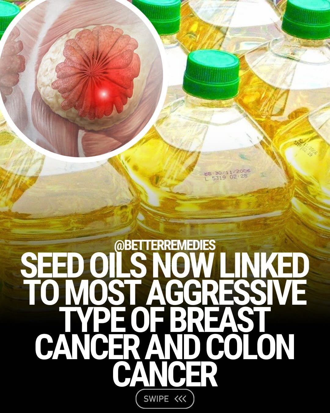 Photo shared by Natural Remedies on February 04, 2026 tagging @naturethecure. May be an image of text that says 'u មន 30- 20/11/2006 12- 2006 ٦ 5319 02.2 80:30g-금212담도 02 28 @BETTERREMEDIES SEED OILS NOW LINKED TO MOST AGGRESSIVE TYPE OF BREAST CANCER AND COLON CANCER SWIPE <<<'.