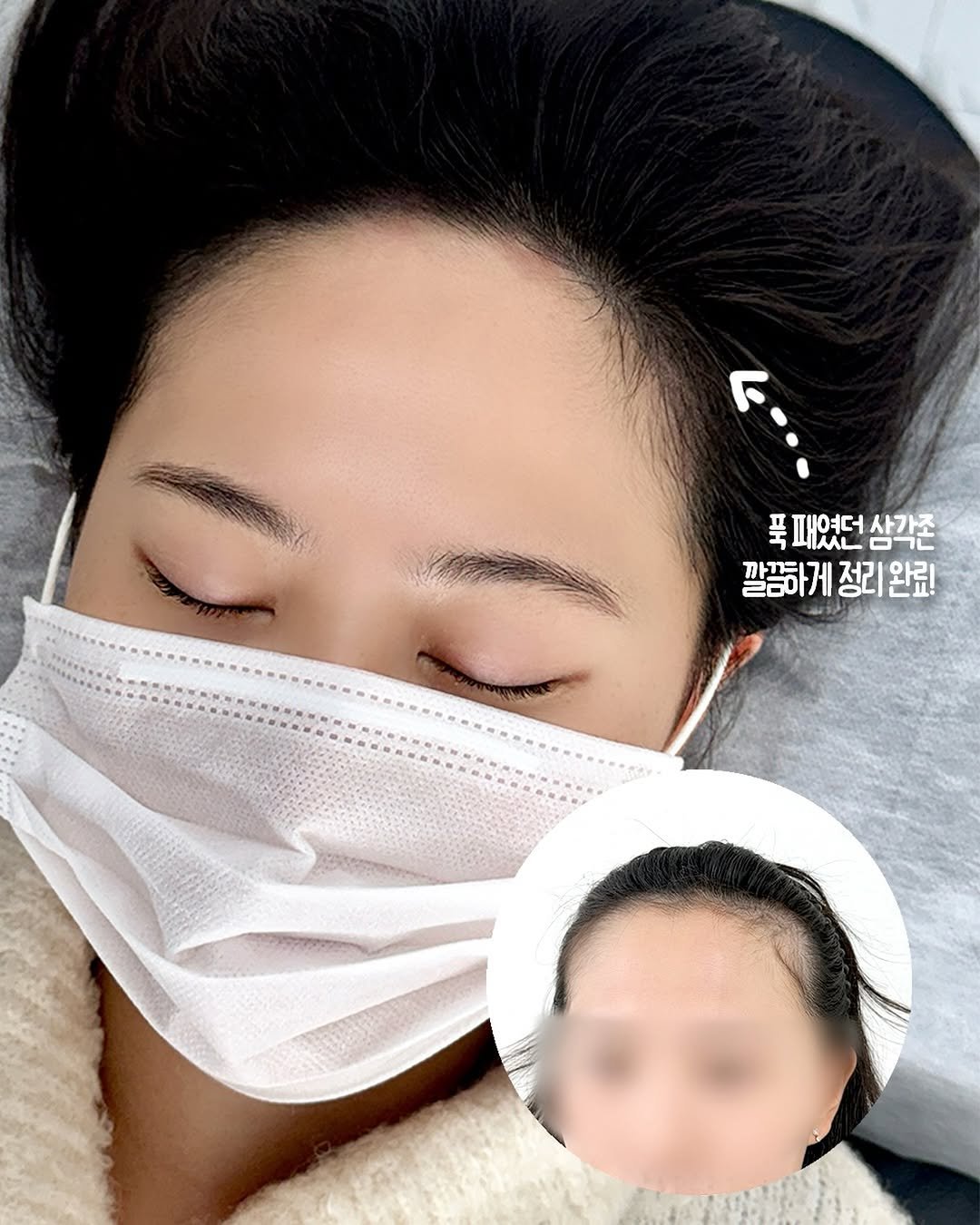 Photo by 잠실두피문신 ◦ 잠실두피문신수강 ◦ 송파두피문신 비비엘 대표원장 | 이선민 in 잠실새내역 with @bibiel_smp. May be an image of one or more people, hair and text that says '푹 패였던 푹패였던상각존 표여 삼각존 깔끔하게 정구 깔끔하게정리완료! 완료!'.