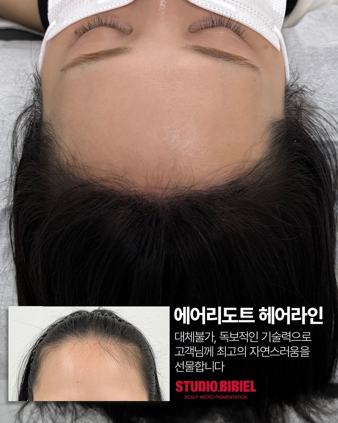 bibiel_smp 게시물 이미지: 잔머리 없이 넓은 케이스✔️
전체적인 모가 얇고 숱이 부족해서
헤어라인을 더 꼼꼼히...