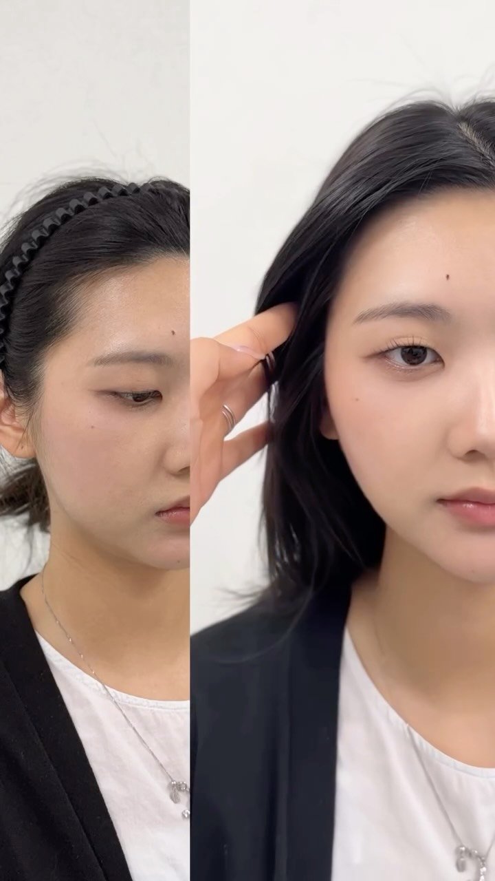 bibiel_smp 게시물 이미지: 헤어라인 시술 받으면 어떻게 보일지 궁금하시죠?!👀
머리띠 하거나 왈칵 넘어간...