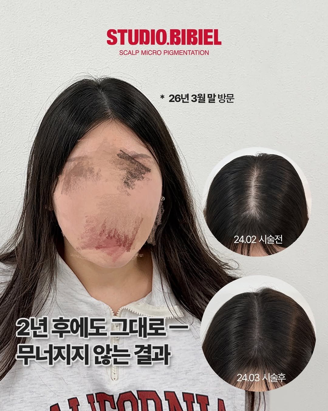 Photo by 잠실두피문신 ◦ 잠실두피문신수강 ◦ 송파두피문신 비비엘 대표원장 | 이선민 in 석촌호수공원. May be an image of one or more people, hair, poster and text that says 'STUDIO.BIBIEL BIBIEL SCALP MICRO PIGMENTATION *26년 26년 3월 26년3월말방문 말 방문 24.02 24.02시술전 시술전 2년후에도그대로- 2년 후에도 고대로- 무너지지 않는 결과 24.03시술후 시술후 24.03'.