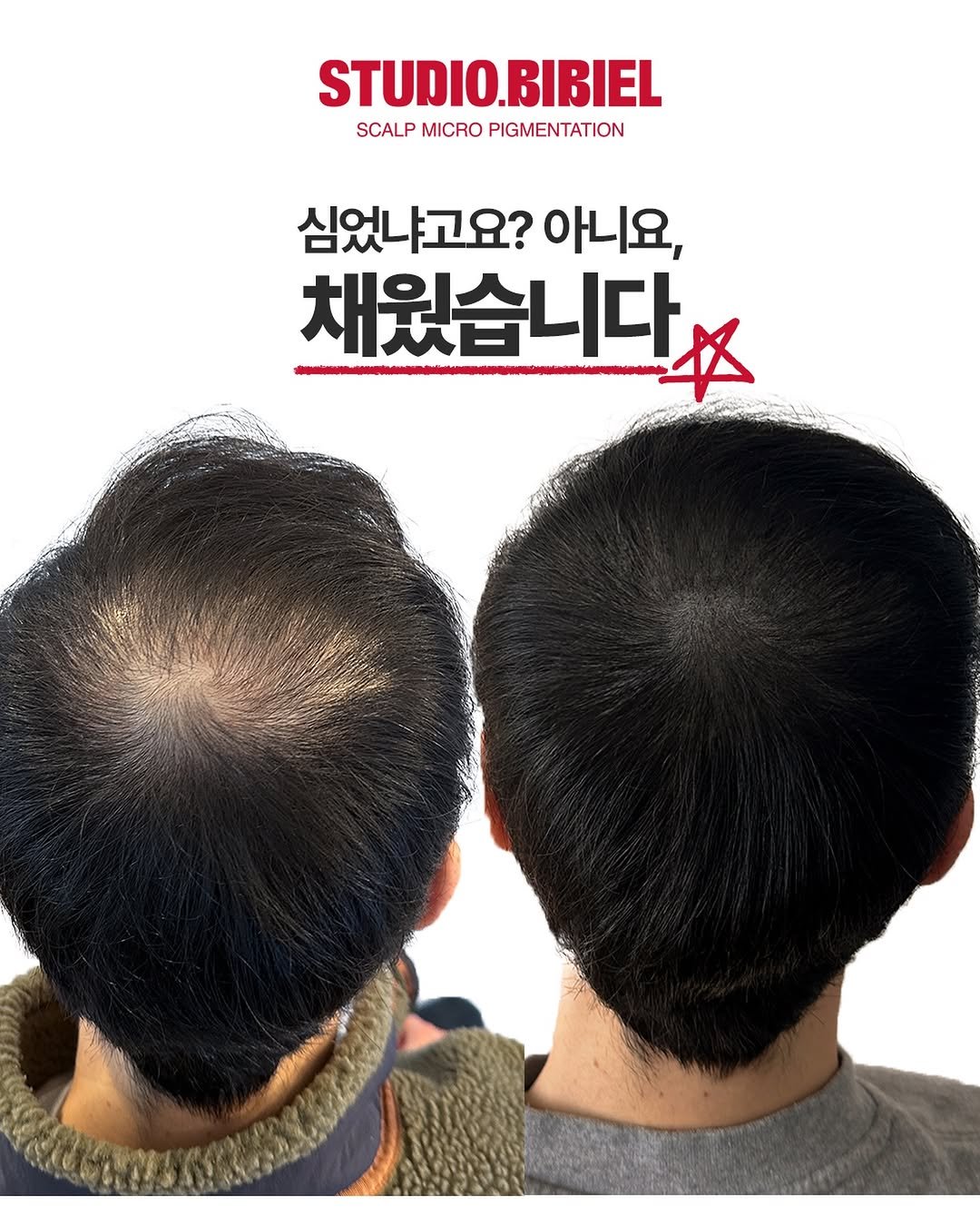 Photo by 잠실두피문신 ◦ 잠실두피문신수강 ◦ 송파두피문신 비비엘 대표원장 | 이선민 in 잠실새내역. May be an image of one or more people, hair and text that says 'STUDIO.BIBIEL SCALP MICRO PIGMENTATION 심었냐고요? 아니요, 채웠습니다'.