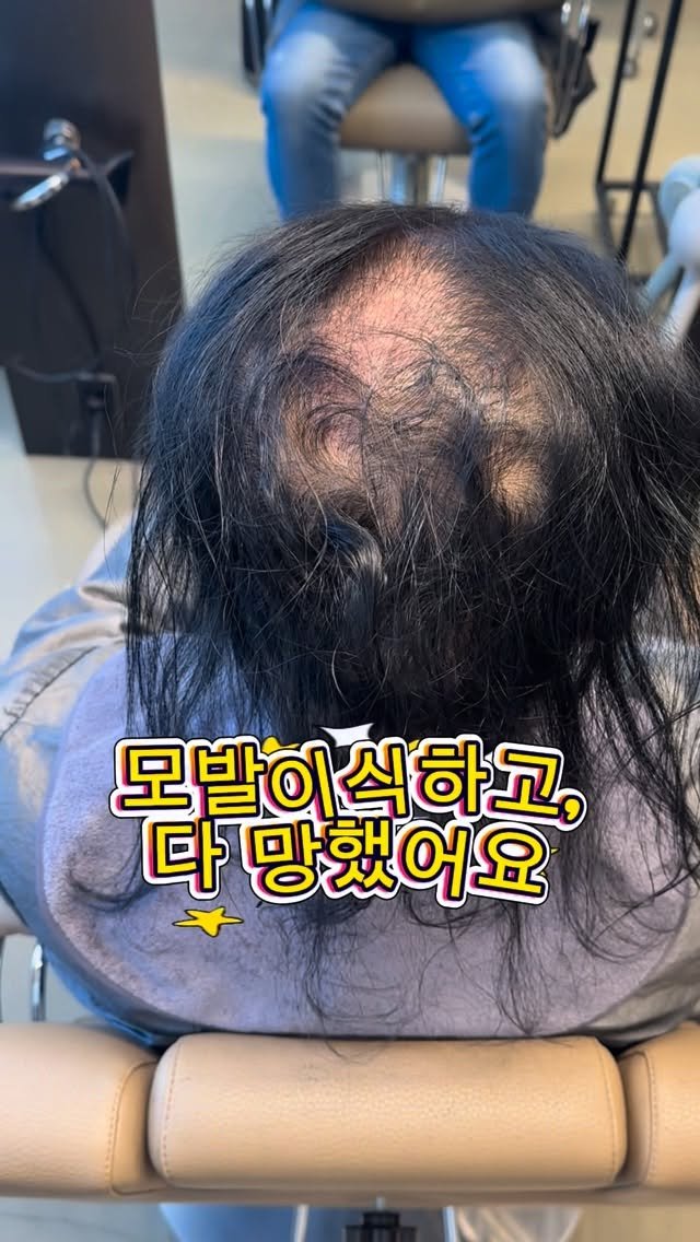 blankyou.eunpa 게시물 이미지: 최근 모발이식수술 자리가
없다. 예약하기 힘들다는 이야기를
들었었는데~ 

그래서...