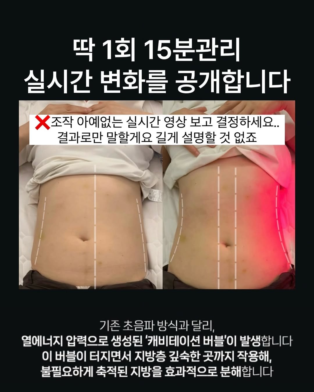 Photo by 최별비 • 다이어트 브랜드 | 디어애프터 on September 13, 2025. May be an image of text that says '딱 1회 15분관리 실시간 변화를 공개합니다 조작 아예없는 실시간 영상 보고 결정하세요.. 결과로만 말할게요 길게 설명할 것 없죠 기존 초음파 방식과 달리, 열에너지 압력으로 생성된 '캐비테이션 버블'이 발생합니다 이 버블이 터지면서 지방층 깊숙한 곳까지 작용해, 불필요하게 축적된 지방을 효과적으로 분해합니다'.