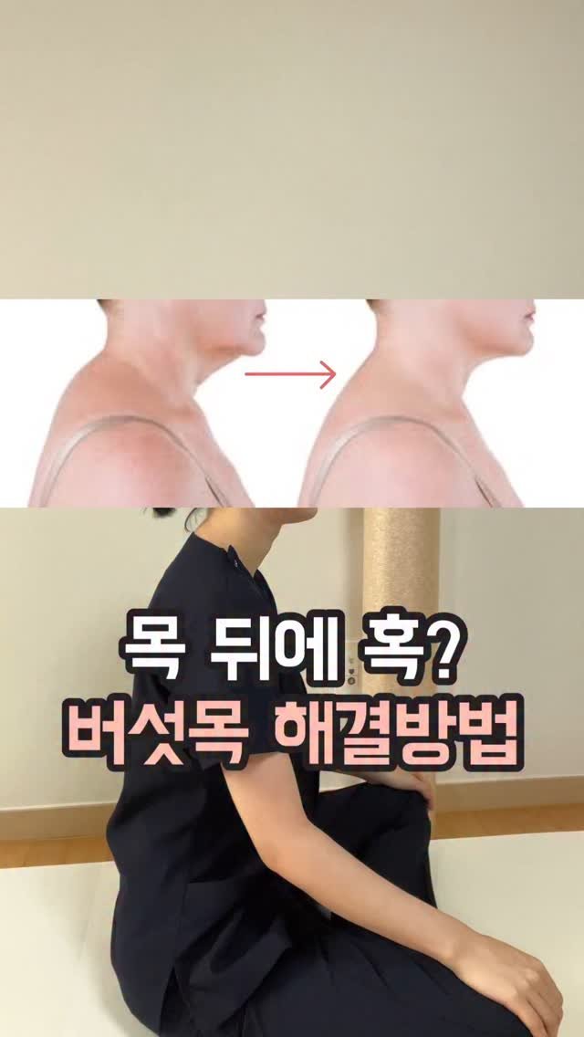 body_heals 게시물 이미지: 🐢🍄 거북목보다 심각한 ‘버섯목’

지금 목 뒤를 만져보세요.
불룩한 덩어리가...