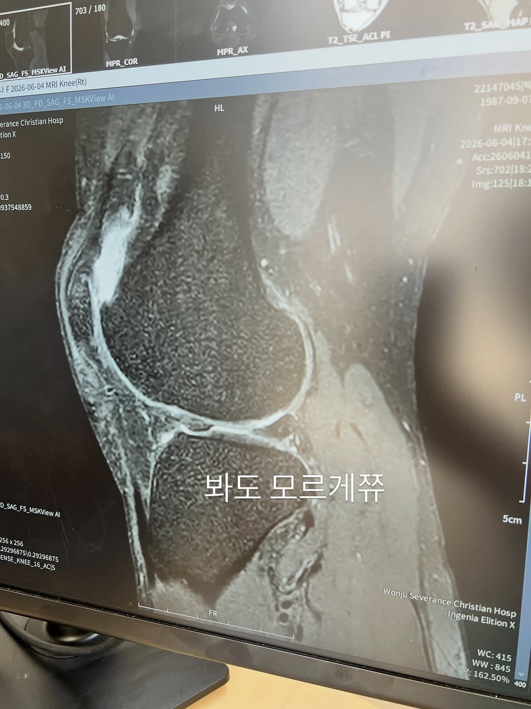 born2fit_natural 게시물 이미지: 🏥진단명 : 
골 연골 결손 / 박리성 골 연골염

😷수술명 : 재대혈 줄기세포...