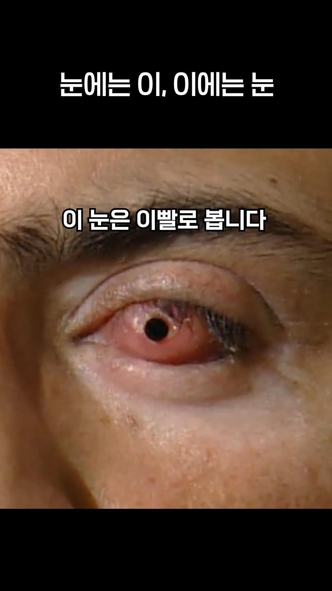 brand_eyeclinic 게시물 이미지: 쓸모없는 사랑니로 실명 해결

#안구내치아수술 #라식 #라섹 #라식수술...