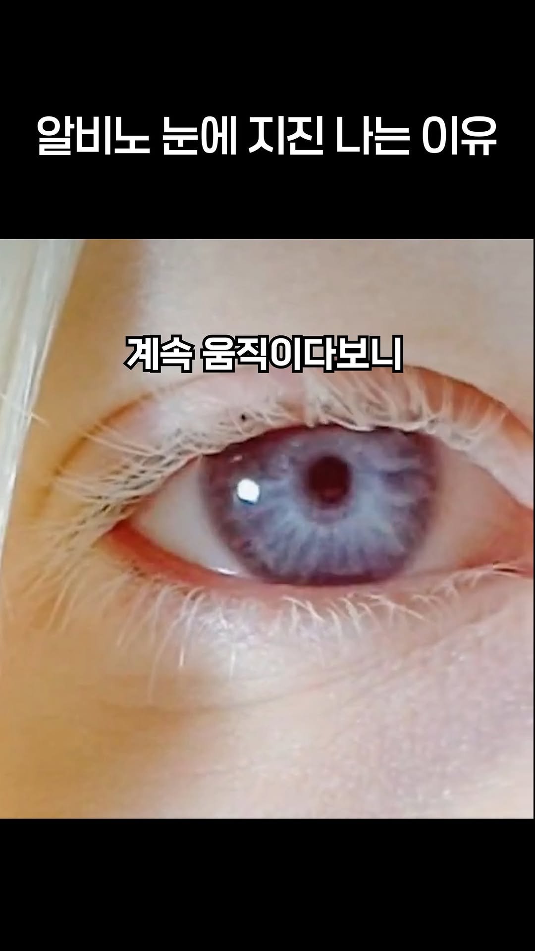 brand_eyeclinic 게시물 이미지: 눈이 제멋대로 날뛰는 이유

#알비노 #라식 #라섹 #라식수술 #라섹수술후기...