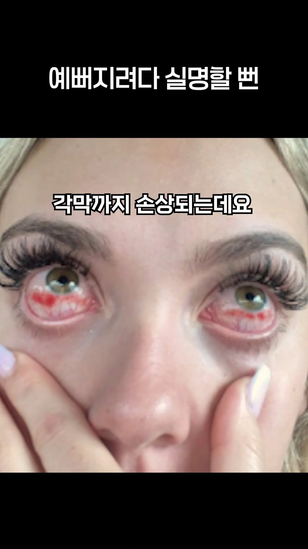 brand_eyeclinic 게시물 이미지: 속눈썹 연장하다 실명 직전까지 간 소녀

#속눈썹연장 #라식 #라섹 #라식수술...