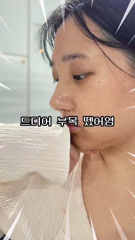 bravelyyoon 게시물 이미지: 코성형 브이로그 2탄

📌제가 최대한 자연스럽게 요청한 이유는 - 제 비포 코가...