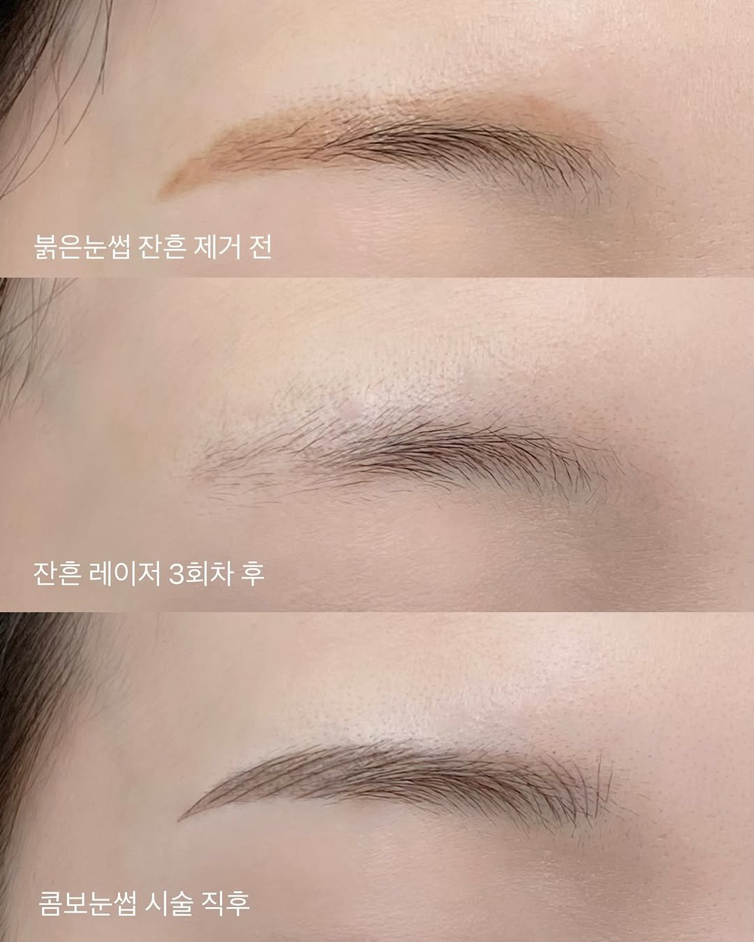 brow_look_ 게시물 이미지: #눈썹제거 #눈썹문신제거 #눈썹제거잘하는곳
 ⠀⠀⠀⠀⠀⠀⠀⠀⠀⠀
요즘 잔흔없는 분들...