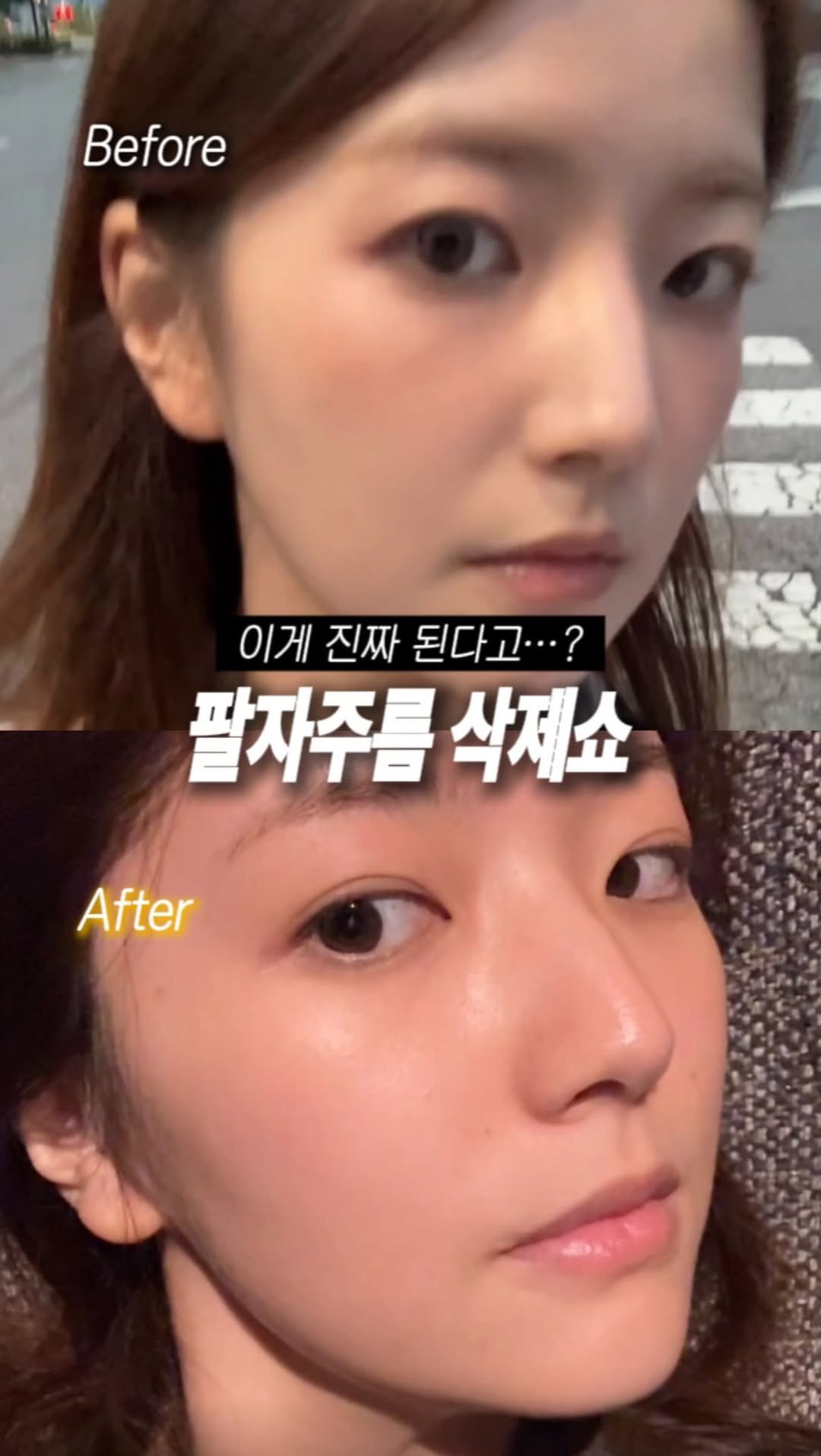 brown.beauuuty 게시물 이미지: 저장•공유📌) 코 옆에 푹 패인 팔자 드디어 해결했어요✨

안 웃어도 짙게 남아있는...