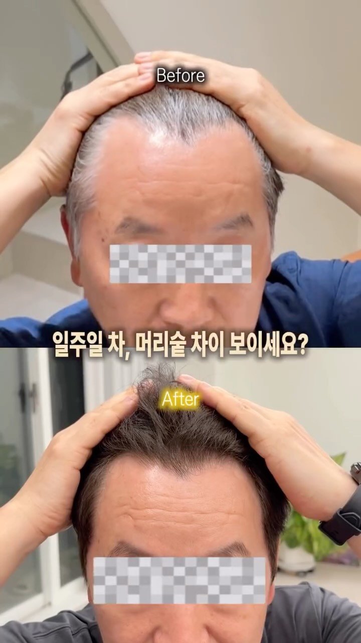 brown.beauuuty 게시물 이미지: [저장•공유📌] 탈모 고민이면 무조건 저장!

손품 팔아서 드디어 찾아낸 
찐...