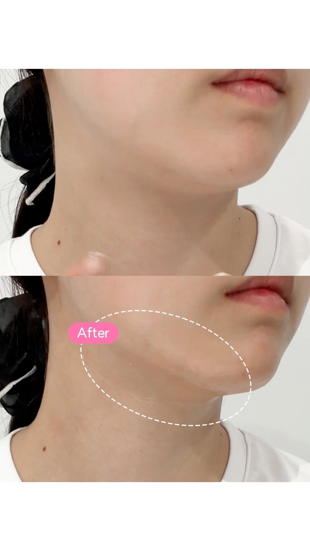 cclime.beauty_kr 게시물 이미지: 끌리메 프로스핀으로 이중턱 삭제 될까?!!!
많은 분들이 궁금해하시길래 끌뷰 담당...