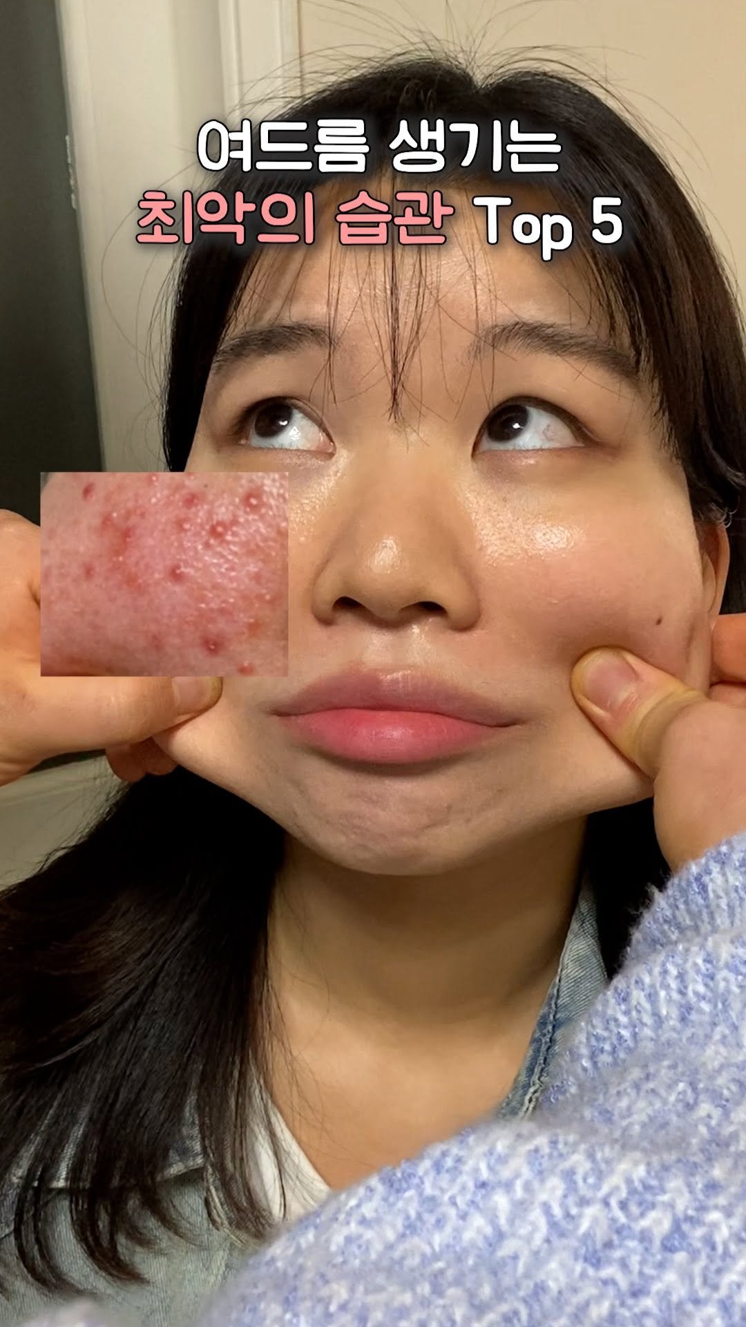 chaeng_trovely 게시물 이미지: 생각나는 사람한테 공유하기 🚨여드름 생기는 최악의 습관 TOP 5

좋은 제품 쓰는...