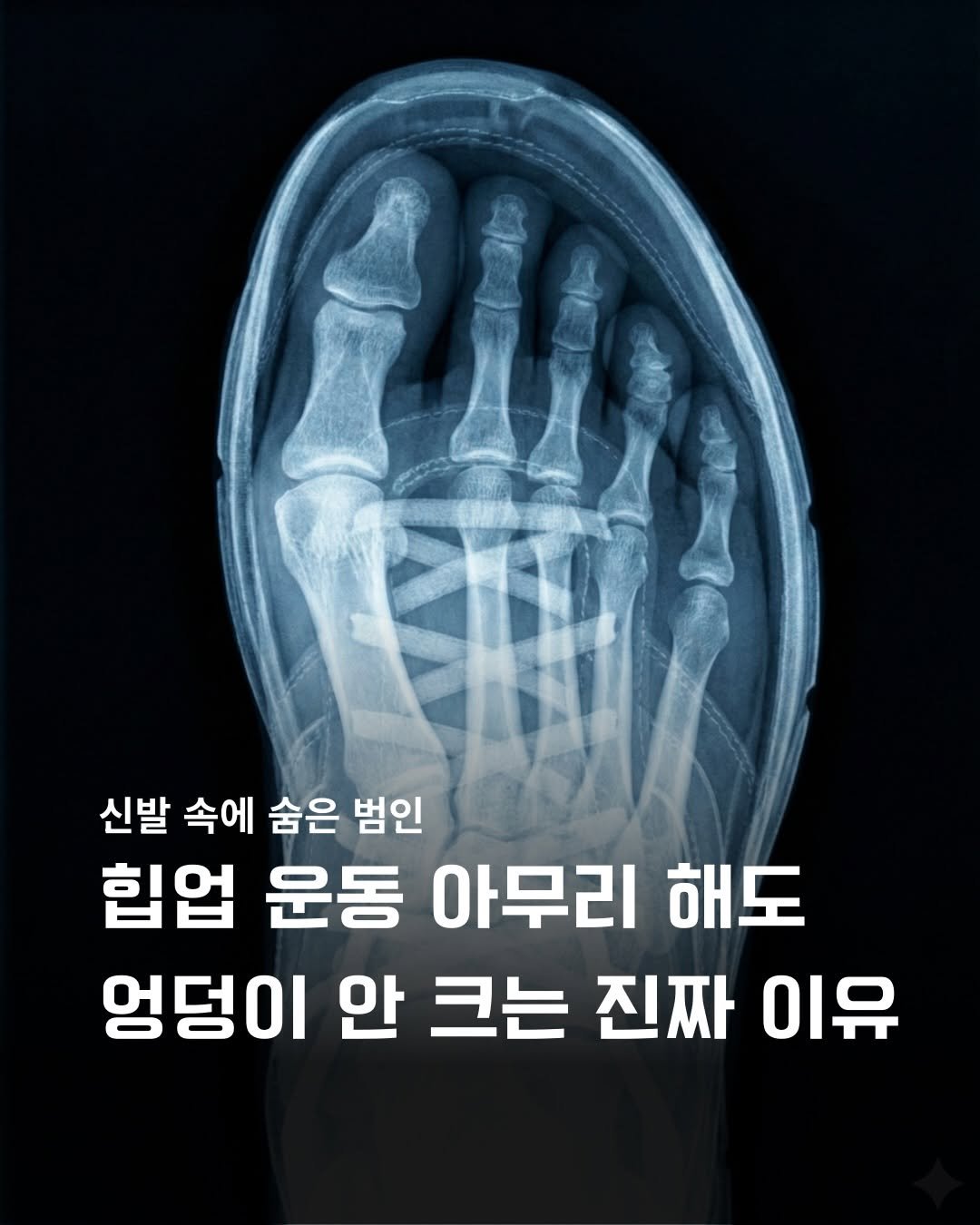 Photo by 바른몸 신선생 | 8년차 트레이너의 꿀팁 모음집 on December 18, 2025. May be an image of xray, bone and text that says '신발 속에 숨은 범인 힙업 운동 아무리 해도 엉덩이 안 크는 진짜 이유'.