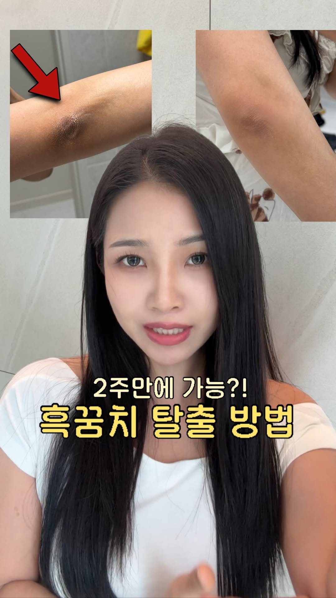 cherrypark9604 게시물 이미지: #광고 거뭇거뭇한 팔꿈치 착색 고민이신 분들 아직 안 늦었어요!!!! 딱 2주만...