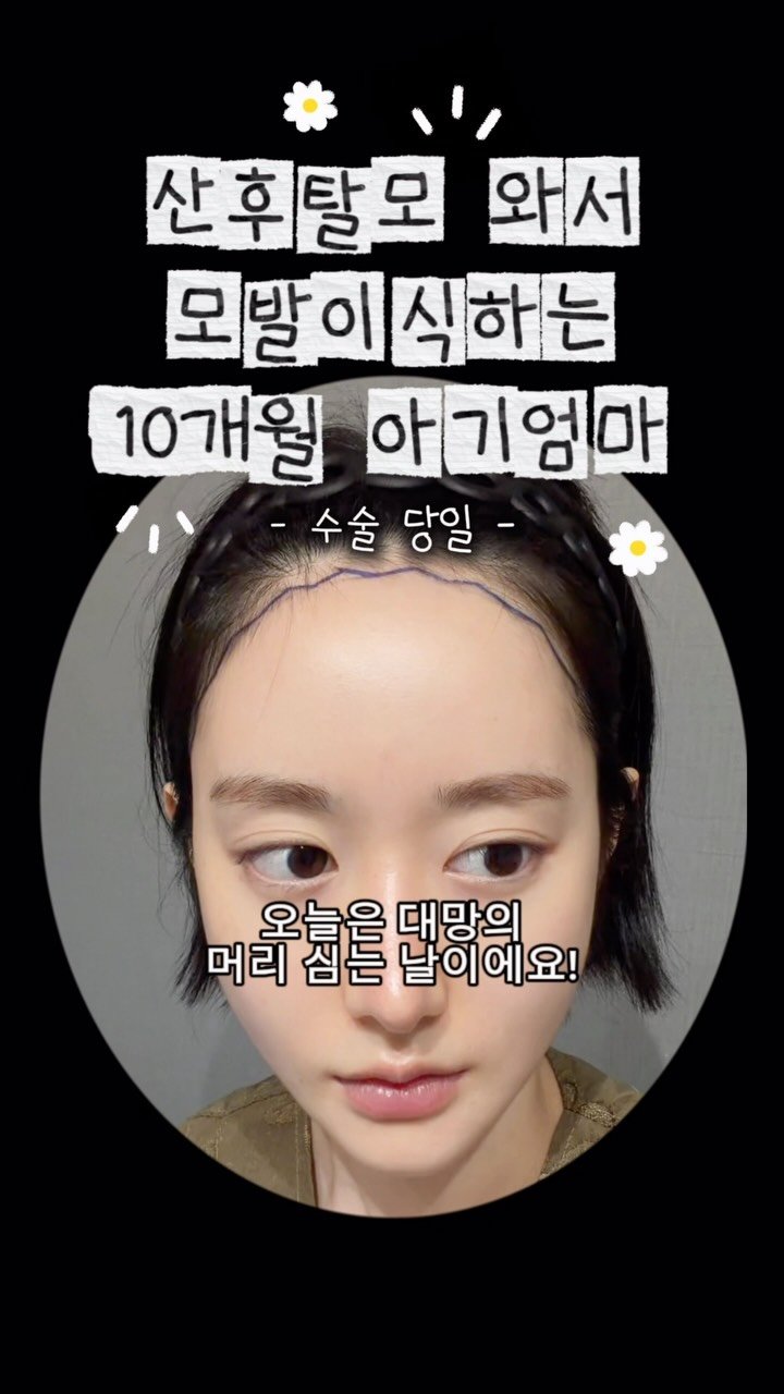 chichipresso 게시물 이미지: 아니 1편 조회수 무슨 일.. 다들 애 낳고 휑해진 헤어라인 때문에 고민이...