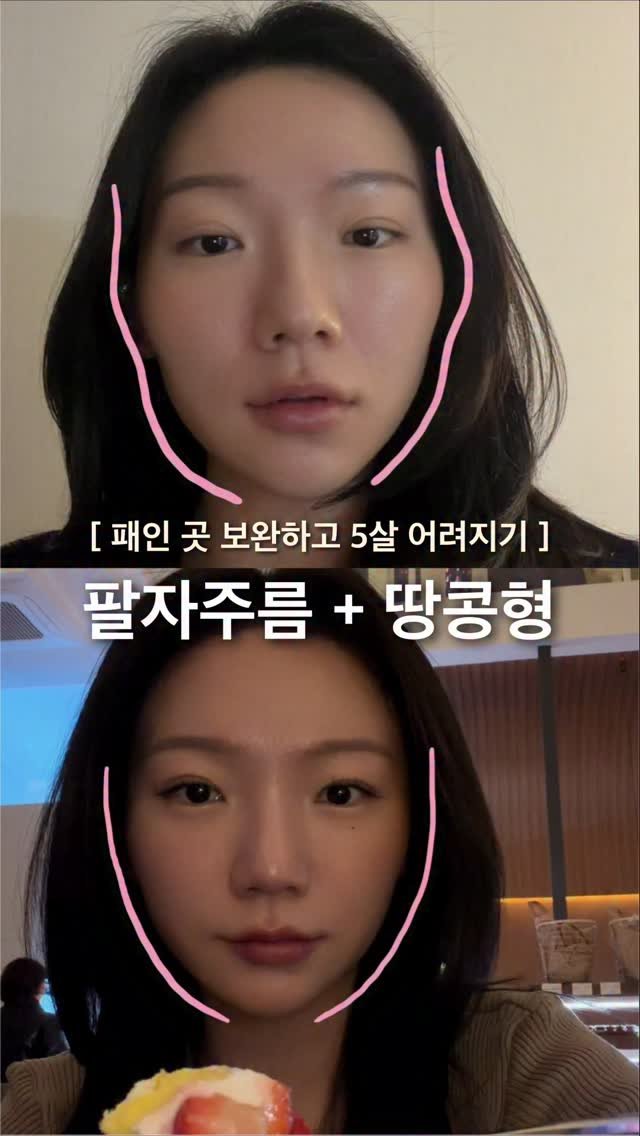 claro_yerin 게시물 이미지: 팔자주름 + 땅콩형 얼굴 
시술 후기 말아왔숨니다

현재 3주차 자연스레 볼륨이...