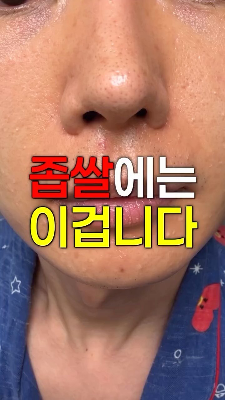 coguy_ 게시물 이미지: 3일만에 좁쌀 여드름 없애는 방법 알려드립니다🔥

#좁쌀 #여드름 #좁쌀여드름 #여드름없애는법