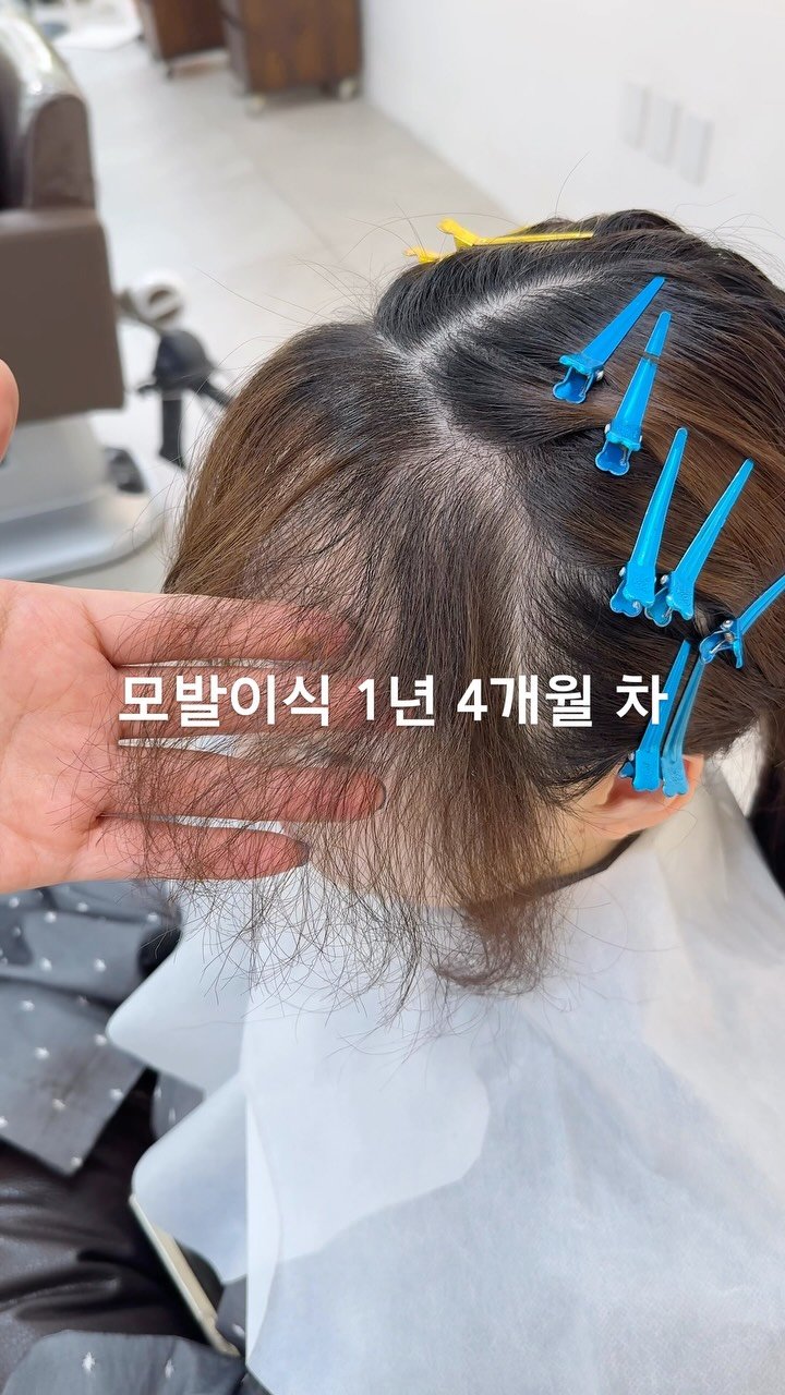 comodo_magic 게시물 이미지: #모발이식매직 
최소 8개월 이상 추천드리고, 
1년을 넘겨야 베스트 시기로...