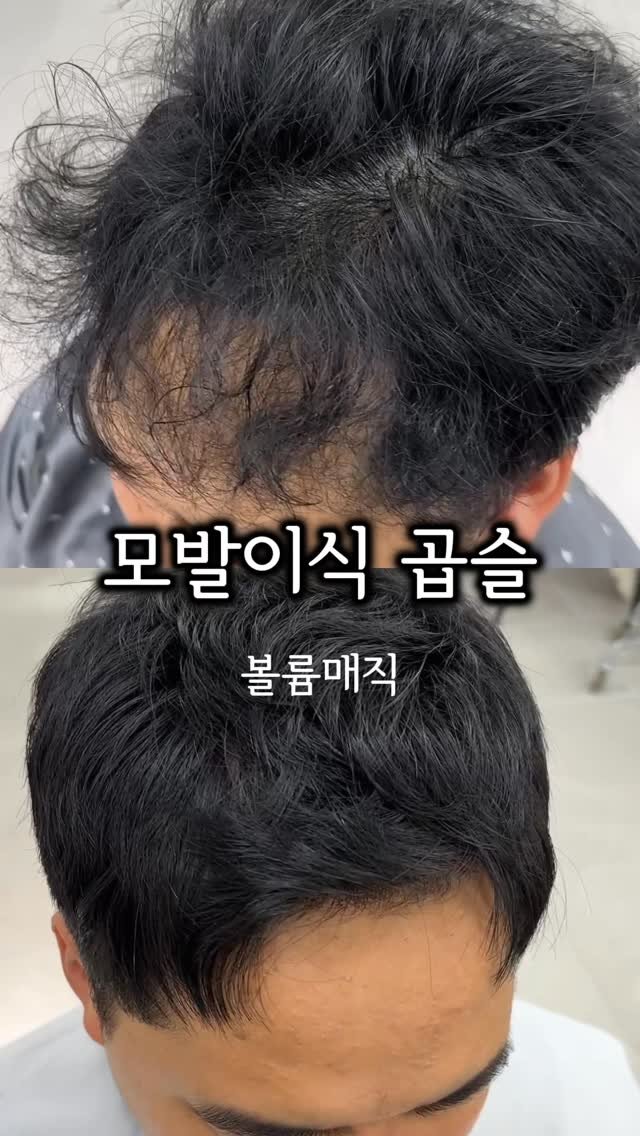 comodo_magic 게시물 이미지: 넓은이마, M자이마 고민하는 남성분들도 요즘 모발이식 정말 많이 하시죠!

하나...