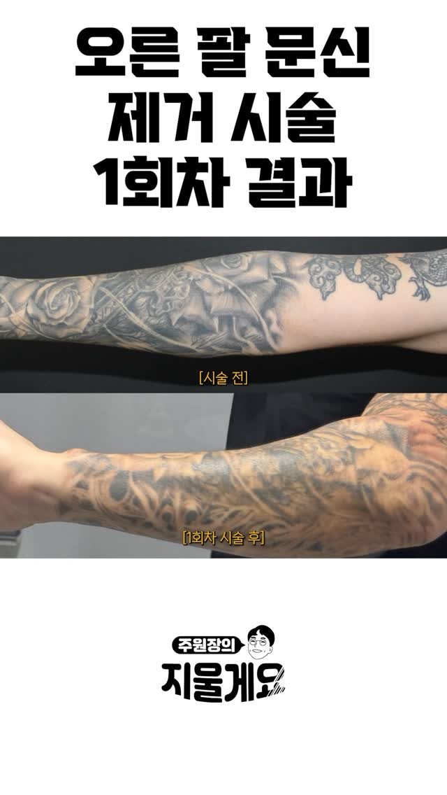 d.derm_ 게시물 이미지: 긴팔문신 1회차 결과 ⭐️
.
.
본편은 유투브 ‘지울게요’ 참고해주세요
#문신제거...