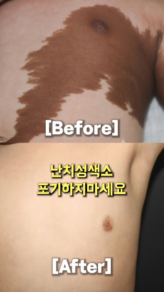 d.derm_ 게시물 이미지: 대형밀크반점 지울 수 있어요 ⭐️
.
.
밀크반점, 베커모반, 군집성흑자증,...