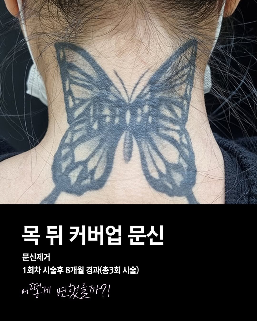 Photo by 주 on March 28, 2026. May be an image of one or more people, tattoo and text that says '목뒤 목 뒤 커버업 문신 문신제거 1회차 시술후 8개월 경과(총3회 시술) 어떻게 변했을까?!'.